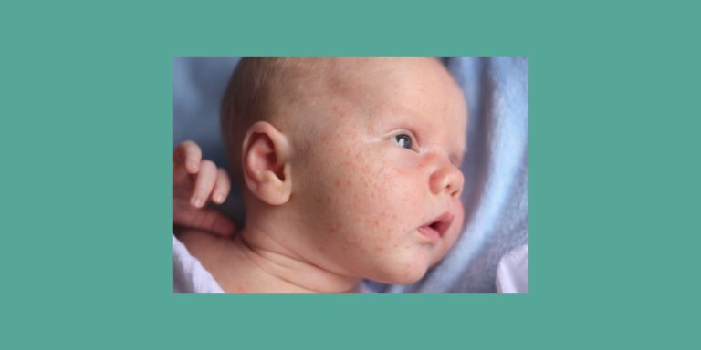 baby acne